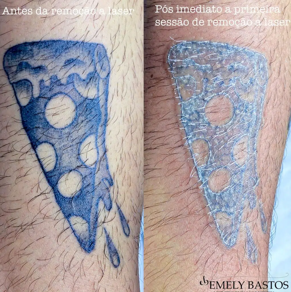 Remoção de tatuagem - Emely Bastos (7)