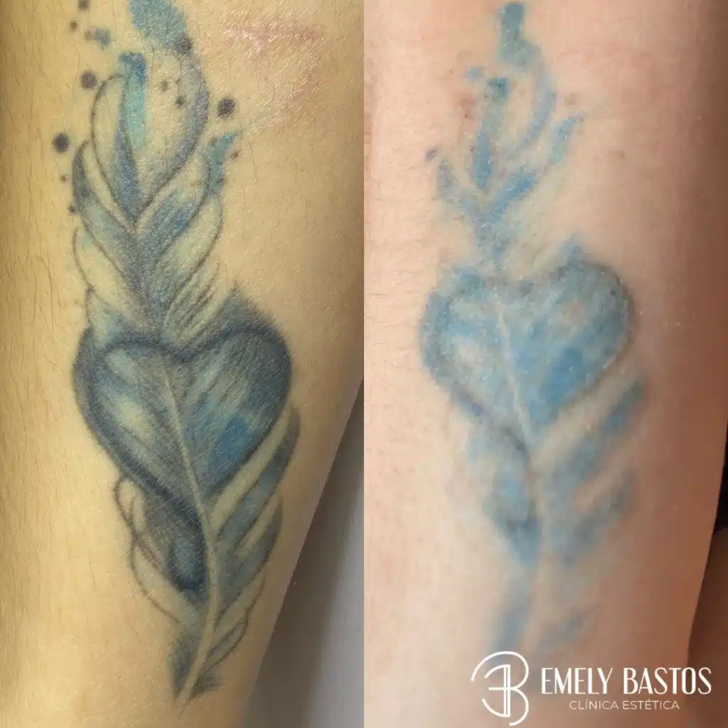 Remoção de tatuagem - Emely Bastos - EB - Clínica Estetica (1)